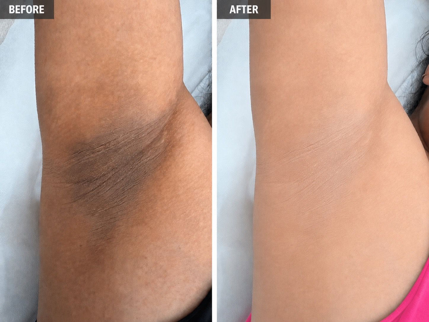 Lightening for Underarm or Intimate Area