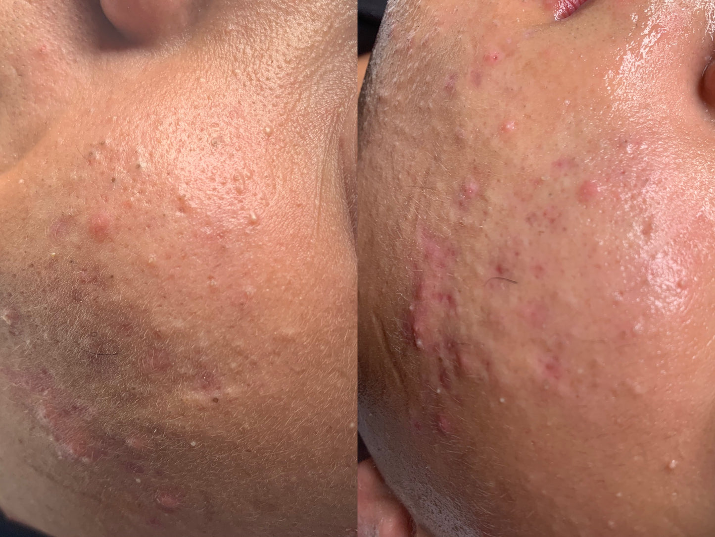 Extractions Facial
