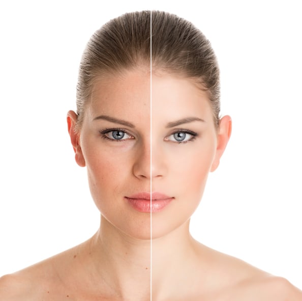 Microdermabrasion