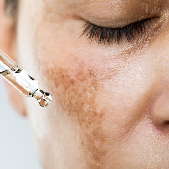 TCA peel 15% treatment