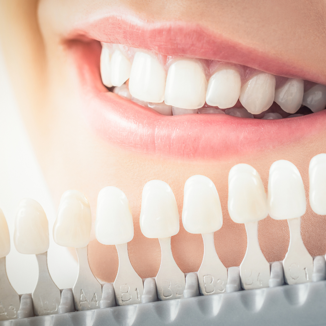 Cosmetic Teeth Whitening