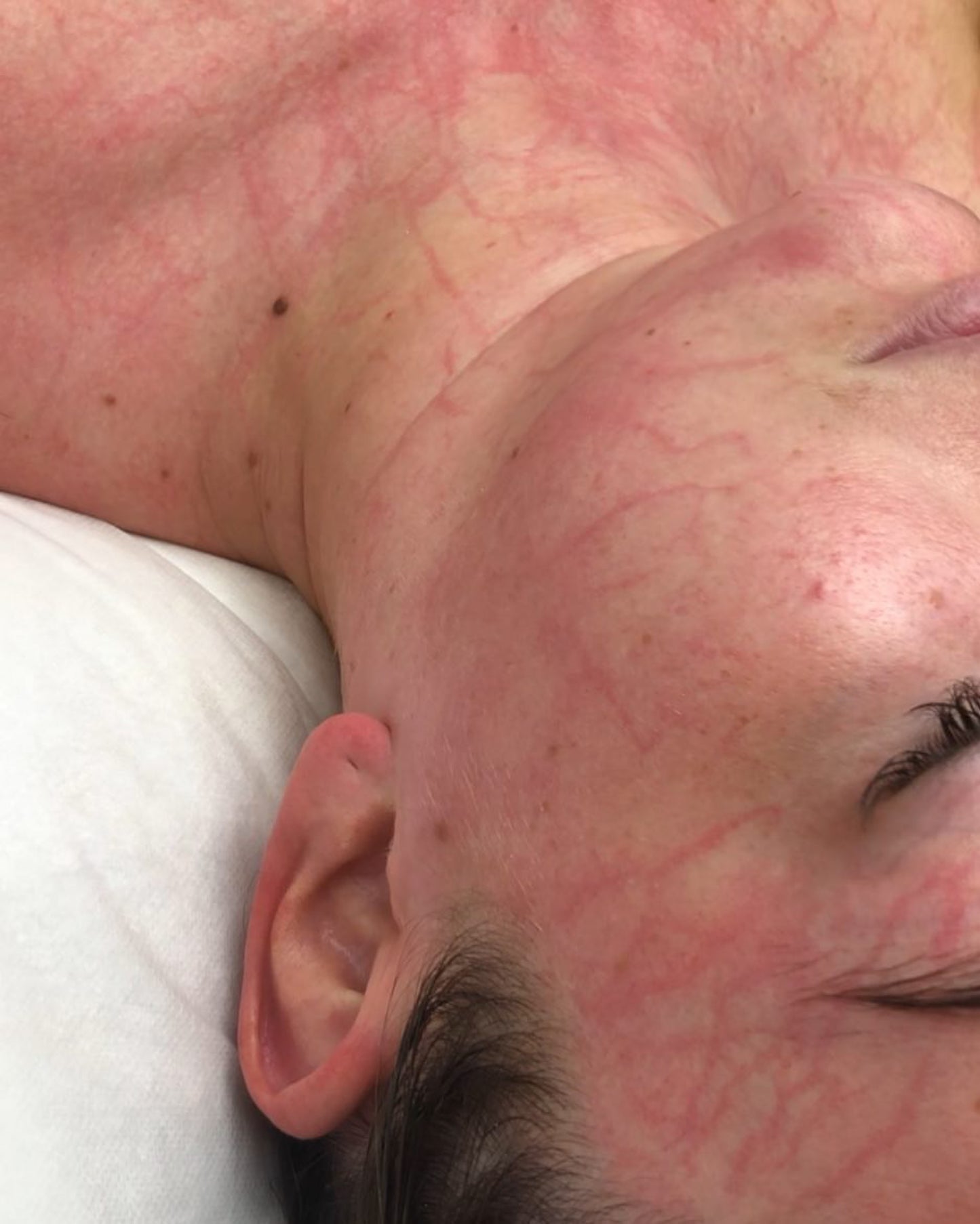 Prin  Enyzme Lymphatic Drainage  Facial