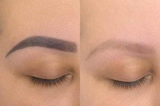 Eyebrow Tattoo Removal