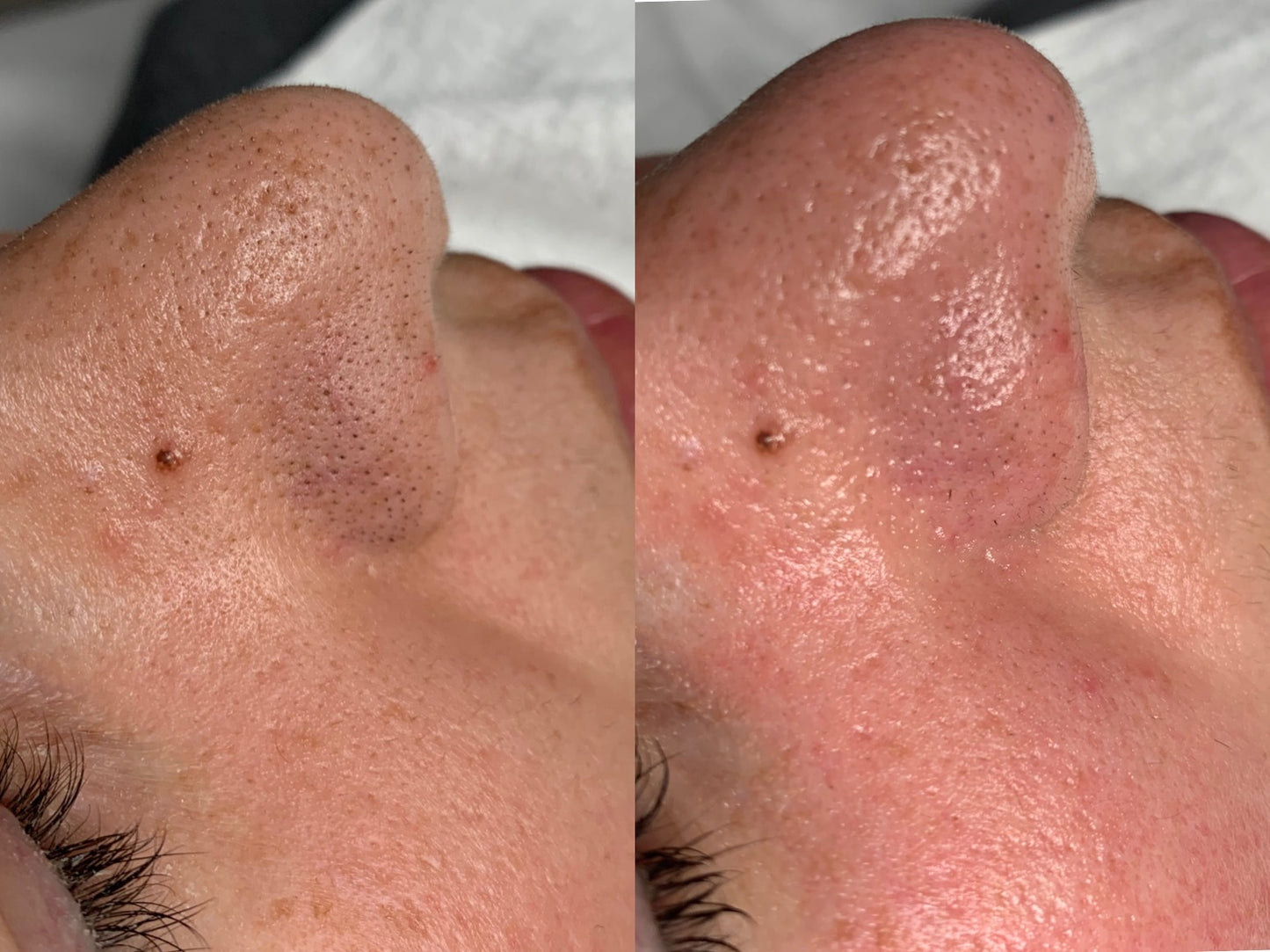 Extractions Facial
