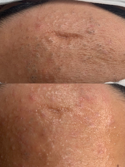 Extractions Facial