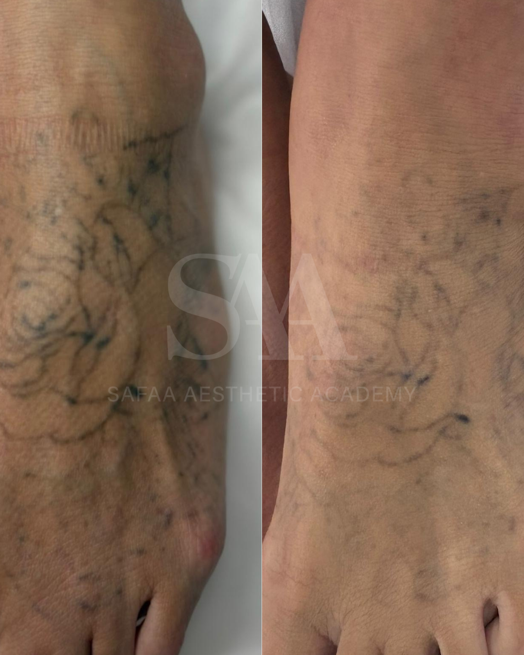Tattoo removal Consultation