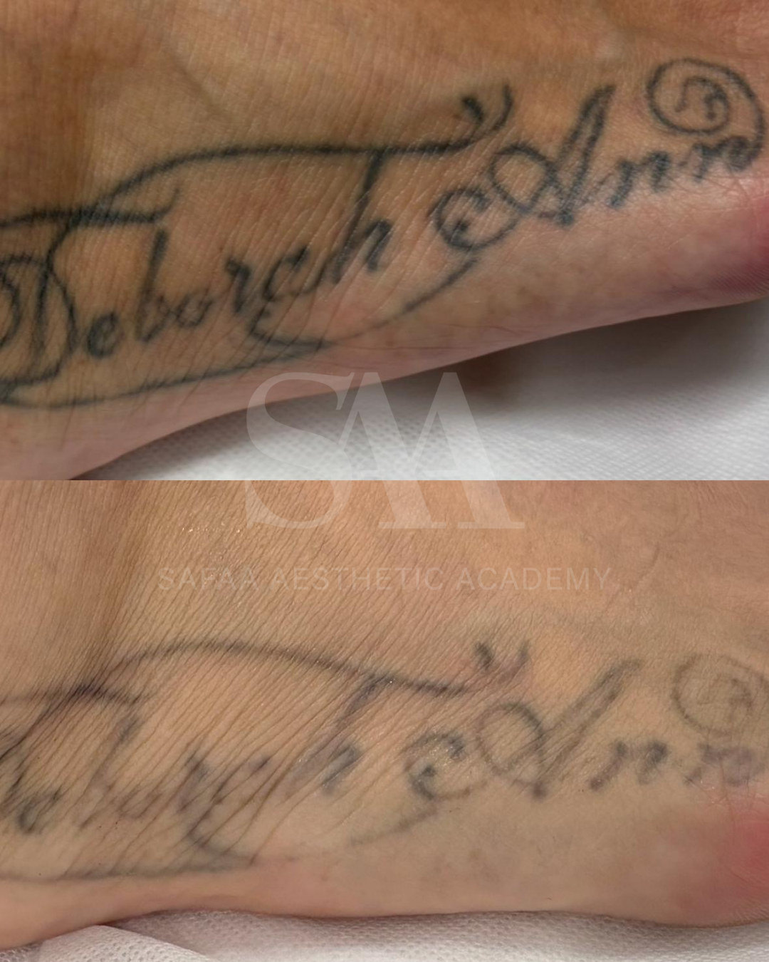 Tattoo removal Consultation